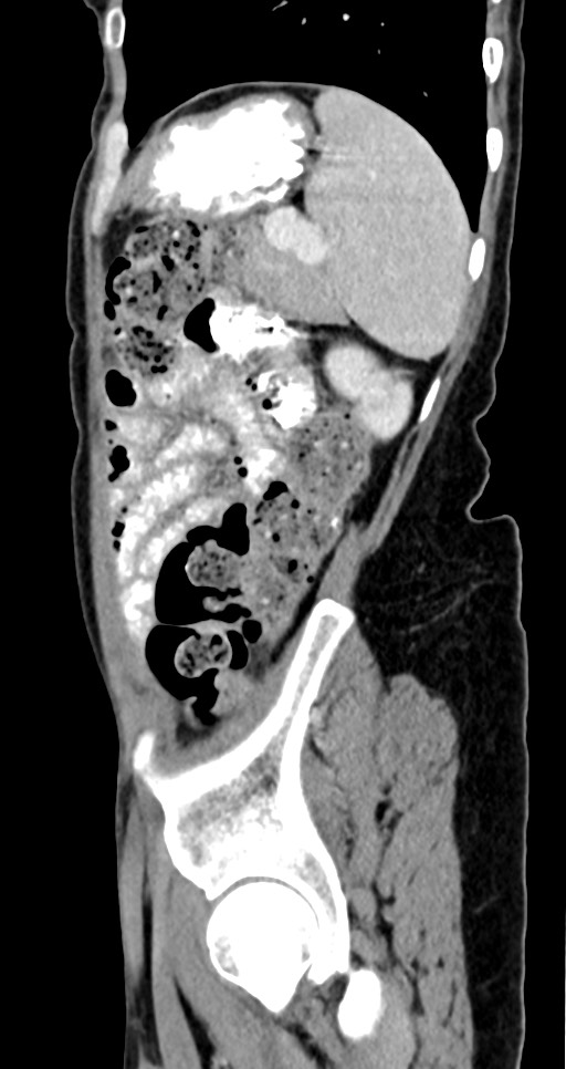 Abdominal wall and retroperitoneal tuberculosis (Radiopaedia 88137-104729 Sagittal C+ portal venous phase 36).jpg
