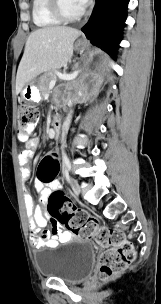 Abdominal wall and retroperitoneal tuberculosis (Radiopaedia 88137-104729 Sagittal C+ portal venous phase 66).jpg