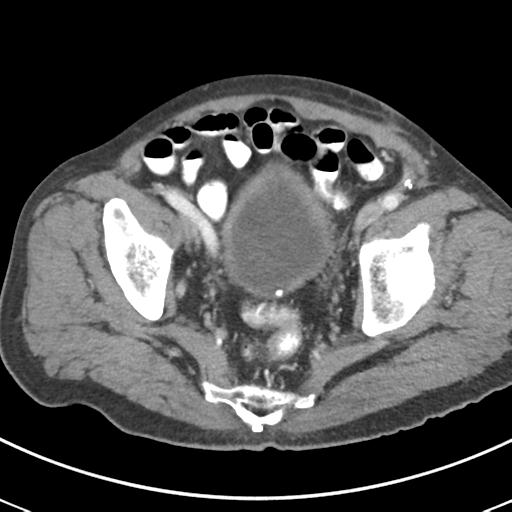 Abdominal wall metastasis from colorectal carcinoma (Radiopaedia 31016-31717 Axial C+ portal venous phase 66).jpg