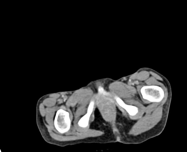 File:Abdominopelvic rhabdomyosarcoma (Radiopaedia 78356-90984 Axial C+ portal venous phase 160).jpg