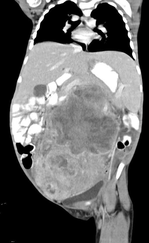 Abdominopelvic rhabdomyosarcoma (Radiopaedia 78356-90984 Coronal C+ portal venous phase 47).jpg
