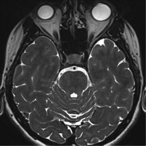 File:Abducens nerve palsy (Radiopaedia 51069-56648 Axial T2 fat sat 46).png