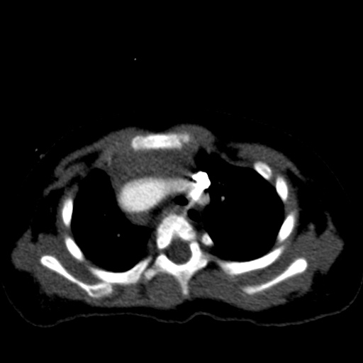 File:Aberrant left pulmonary artery (pulmonary sling) (Radiopaedia 42323-45435 Axial C+ CTPA 15).jpg