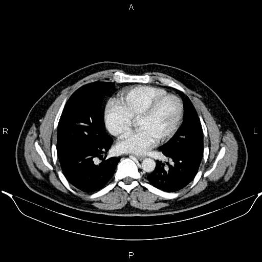 File:Aberrant right subclavian artery (Radiopaedia 87093-103354 Axial With contrast 68).jpg