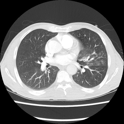 Accessory left horizontal fissure with lingular pneumonia (Radiopaedia 53763-59843 Axial lung window 31).jpg