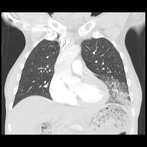 Accessory left horizontal fissure with lingular pneumonia (Radiopaedia 53763-59843 Coronal lung window 18).jpg