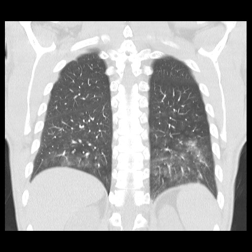 Accessory left horizontal fissure with lingular pneumonia (Radiopaedia 53763-59843 Coronal lung window 35).jpg