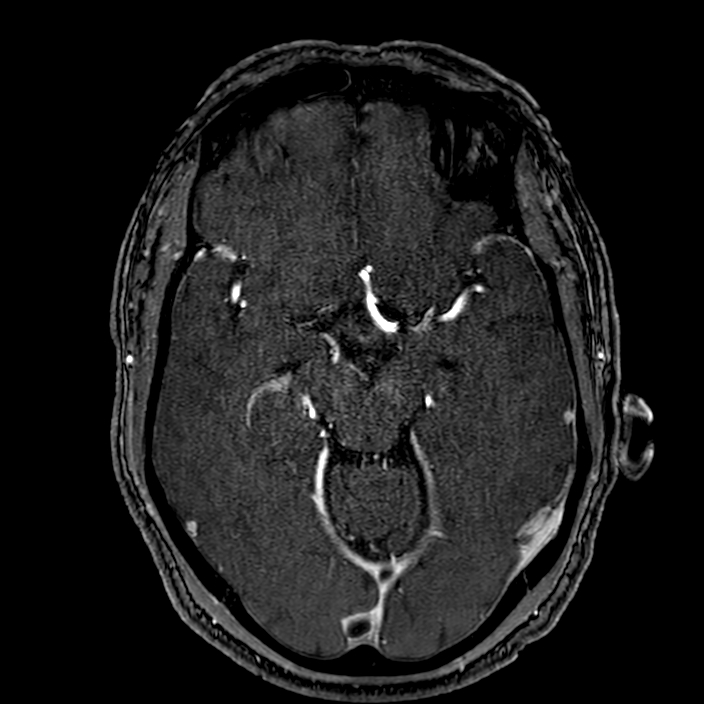 Accessory middle cerebral artery (Radiopaedia 73114-83828 Axial MRA 77).jpg