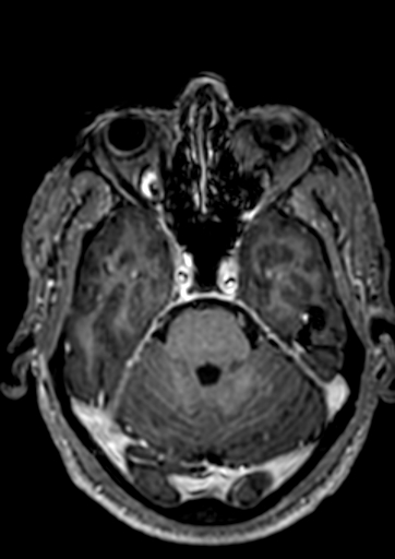 Accessory middle cerebral artery (Radiopaedia 73114-83828 Axial T1 C+ 107).jpg