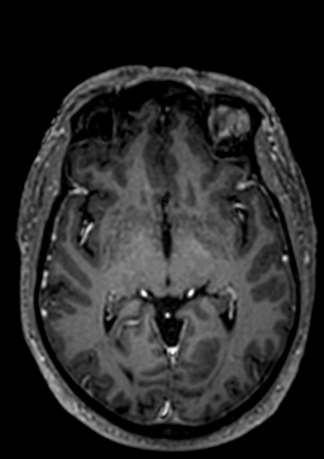 File:Accessory middle cerebral artery (Radiopaedia 73114-83828 Axial T1 C+ 52).jpg