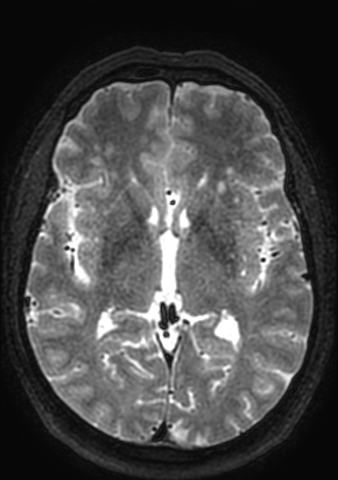 Accessory middle cerebral artery (Radiopaedia 73114-83828 Axial T2 73).jpg