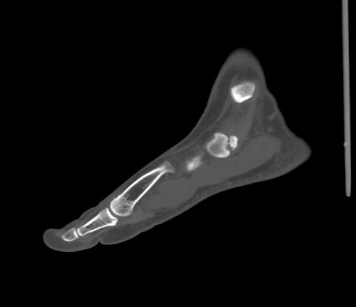 File:Accessory navicular bone (Radiopaedia 54999-61314 Sagittal non-contrast 27).jpg