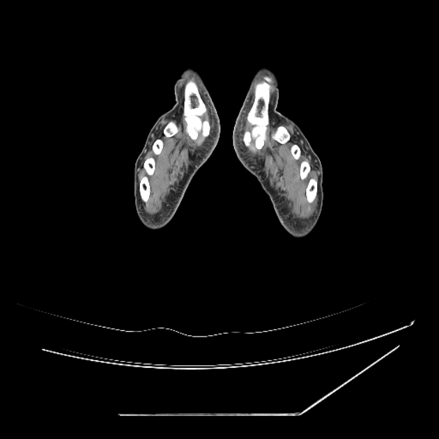 Accessory soleus muscle (Radiopaedia 61069-68943 Axial non-contrast 95).jpg