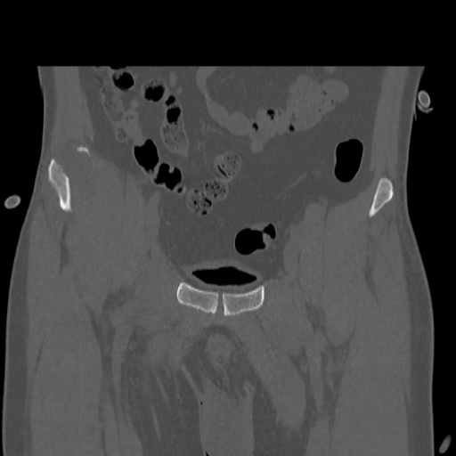 Acetabular and ilial fractures (Radiopaedia 59084-66378 Coronal bone window 12).jpg