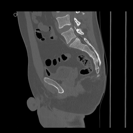 Acetabular and ilial fractures (Radiopaedia 59084-66378 Sagittal bone window 55).jpg