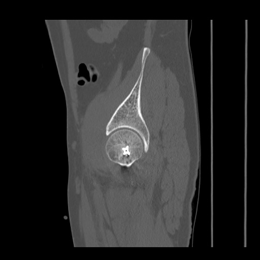 Acetabular and ilial fractures (Radiopaedia 59084-66378 Sagittal bone window 78).jpg