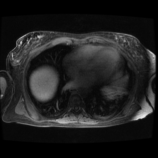 Acinar cell carcinoma of the pancreas (Radiopaedia 75442-86668 Axial late phase (~30 mins) 142).jpg
