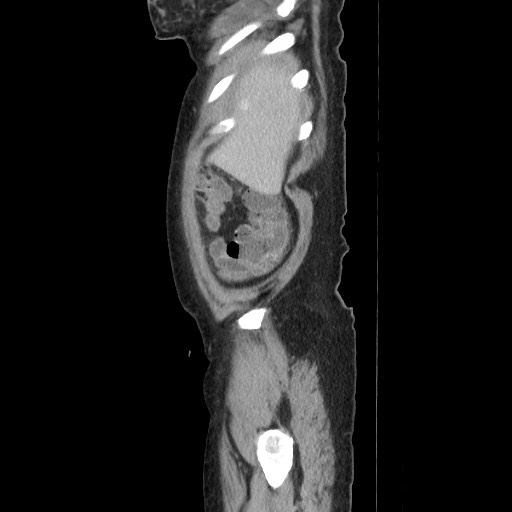 Acinar cell carcinoma of the pancreas (Radiopaedia 75442-86669 Sagittal C+ portal venous phase 33).jpg
