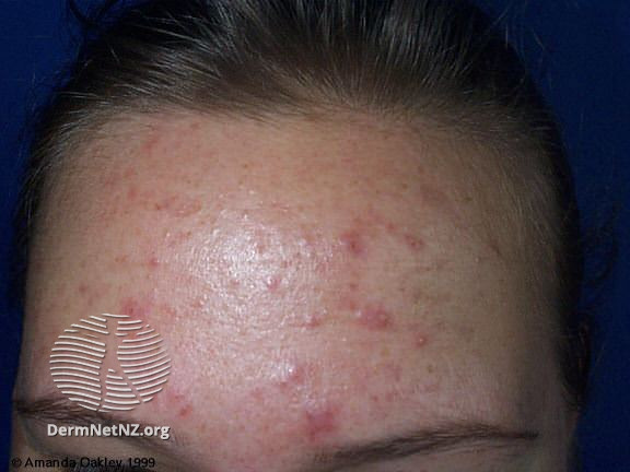 File:Acne in pregnancy (DermNet NZ acne-forehead2).jpg