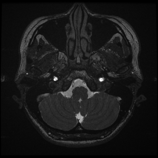 Acoustic neuroma (Radiopaedia 34049-35283 Axial 20).png