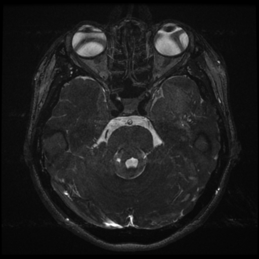 Acoustic neuroma (Radiopaedia 34049-35283 Axial 77).png