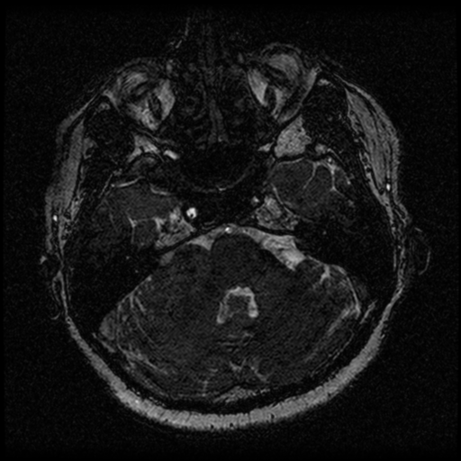 Acoustic schwannoma (Radiopaedia 33045-34060 Axial T2 31).png