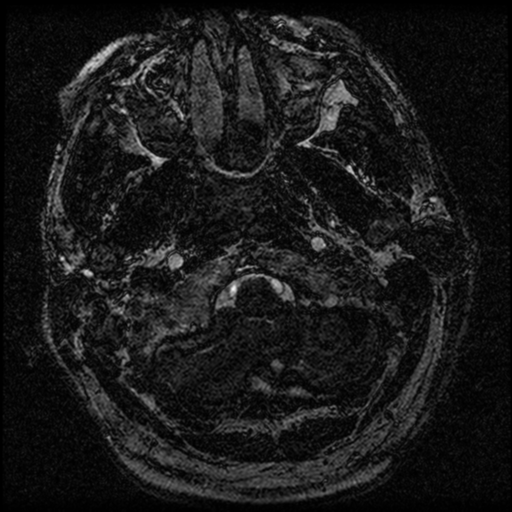 File:Acoustic schwannoma (Radiopaedia 39170-41387 Axial FIESTA 9).png