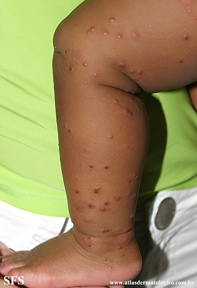 Acrodermatitis Infantile Papular (Dermatology Atlas 29).jpg