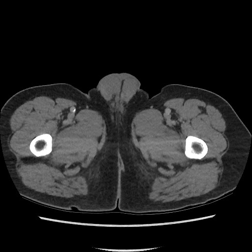 File:Active colonic bleed on CT (Radiopaedia 49765-55025 Axial C+ delayed 95).jpg