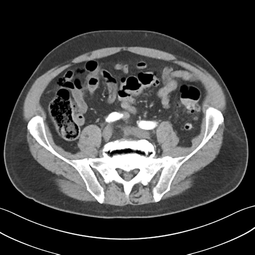File:Active diverticular hemorrhage (Radiopaedia 39415-41725 Axial C+ arterial phase 46).png