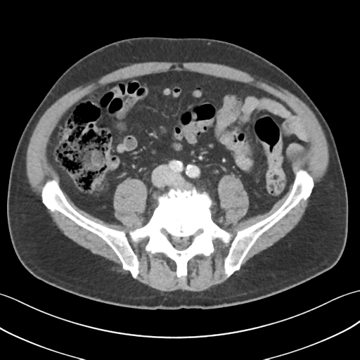 File:Active diverticular hemorrhage (Radiopaedia 39415-41725 Axial C+ portal venous phase 43).png
