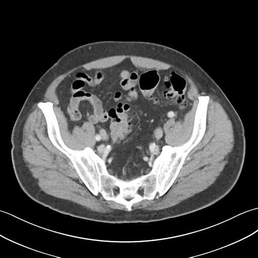 File:Active diverticular hemorrhage (Radiopaedia 39415-41725 Axial C+ portal venous phase 53).png