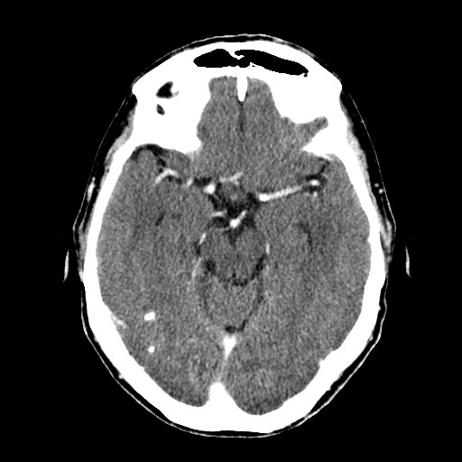 File:Active neurocysticercosis before and after therapy (Radiopaedia 71710-82100 Axial C+ delayed 30).jpg