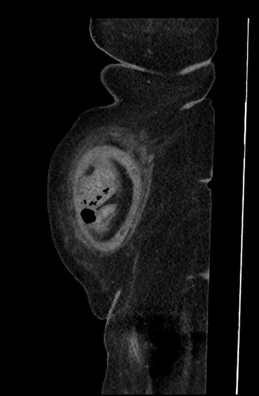 Active renal extravasation with large subcapsular and retroperitoneal hemorrhage (Radiopaedia 60975-68796 Sagittal C+ portal venous phase 201).jpg