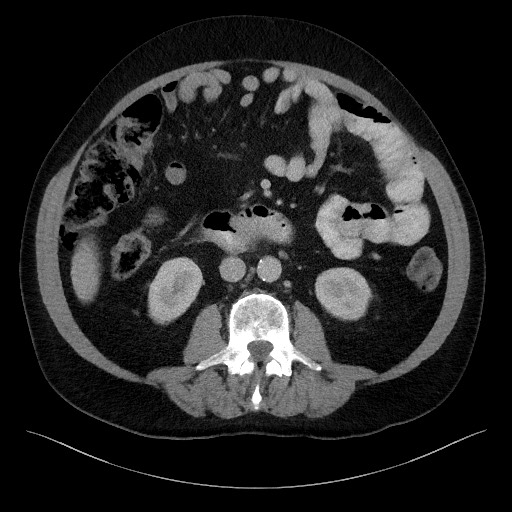 Acute-on-chronic pancreatitis (Radiopaedia 67286-76656 Axial C+ portal venous phase 39).jpg