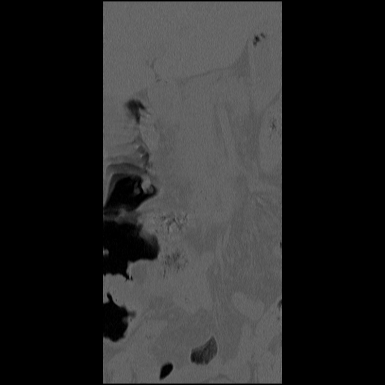 Acute Schmorl's node (Radiopaedia 83276-102365 Coronal bone window 1).jpg