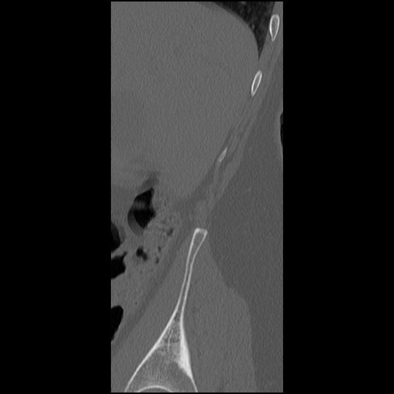 Acute Schmorl's node (Radiopaedia 83276-102365 Sagittal bone window 80).jpg