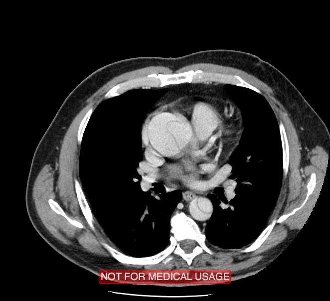 Acute aortic dissection - Stanford type A (Radiopaedia 40661-43285 Axial C+ portal venous phase 26).jpg