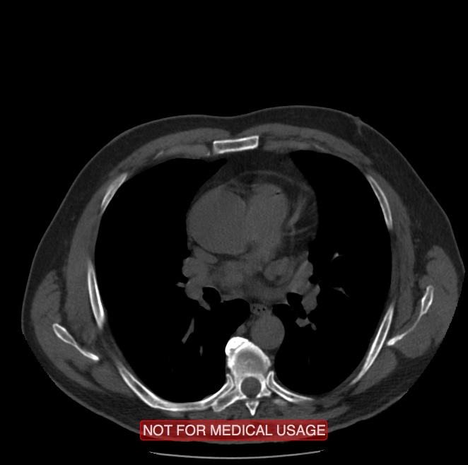 Acute aortic dissection - Stanford type A (Radiopaedia 40661-43285 Axial non-contrast 27).jpg
