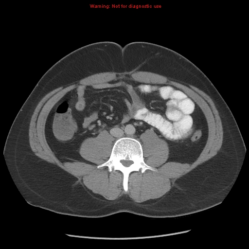 File:Acute appendicitis (Radiopaedia 10498-10973 Axial C+ portal venous phase 4).jpg