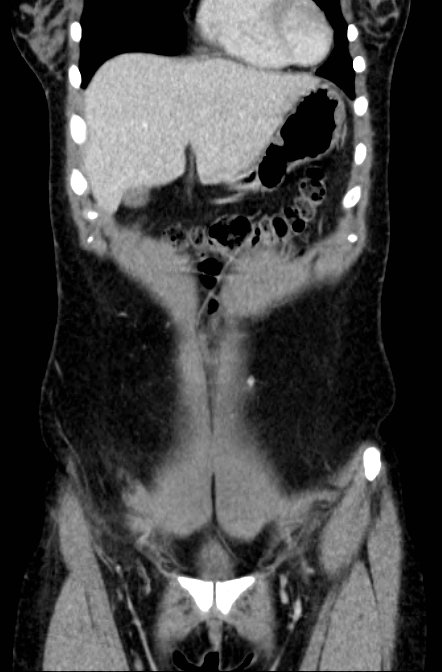 Acute appendicitis (Radiopaedia 22892-22918 Coronal C+ portal venous phase 8).png