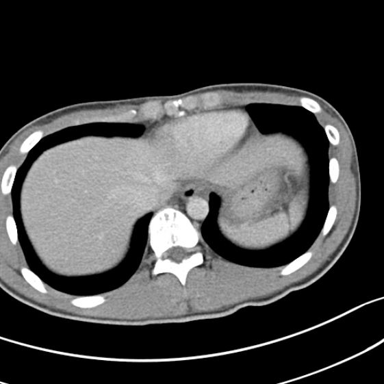 Acute appendicitis (Radiopaedia 32614-33572 Axial C+ portal venous phase 5).jpg