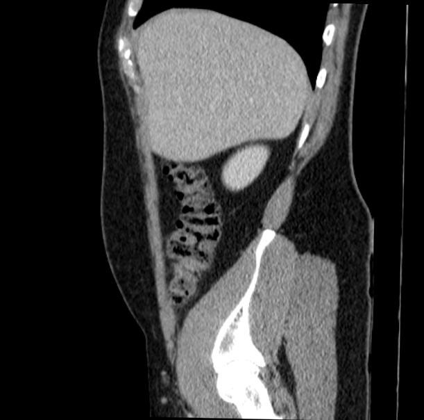 Acute appendicitis (Radiopaedia 38255-40270 Sagittal C+ portal venous phase 18).jpg
