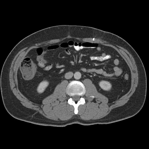 Acute appendicitis (Radiopaedia 48511-53463 Axial C+ portal venous phase 50).jpg