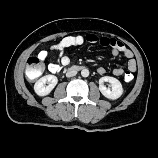 Acute appendicitis (Radiopaedia 77016-88960 Axial C+ portal venous phase 70).jpg