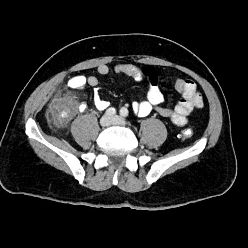 Acute appendicitis (Radiopaedia 77016-88960 Axial C+ portal venous phase 95).jpg