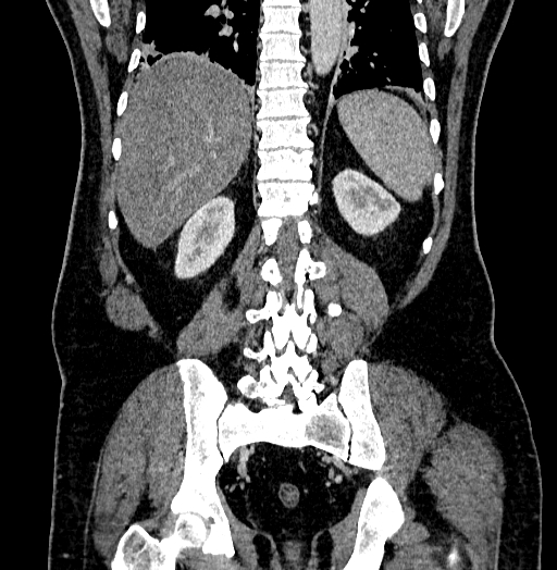 Acute appendicitis (Radiopaedia 79950-93224 Coronal C+ portal venous phase 69).jpg