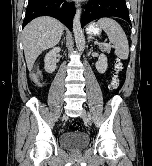 Acute appendicitis (Radiopaedia 84780-100240 Coronal C+ portal venous phase 49).jpg
