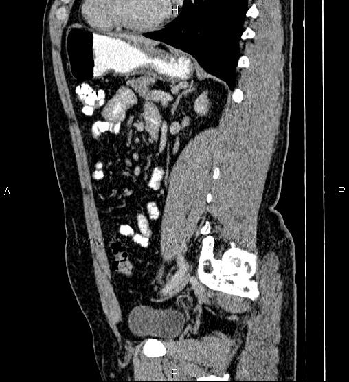 Acute appendicitis (Radiopaedia 84780-100240 Sagittal C+ portal venous phase 66).jpg