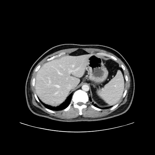 Acute appendicitis and COVID 19 pneumonia (Radiopaedia 76604-88380 Axial C+ portal venous phase 16).jpg